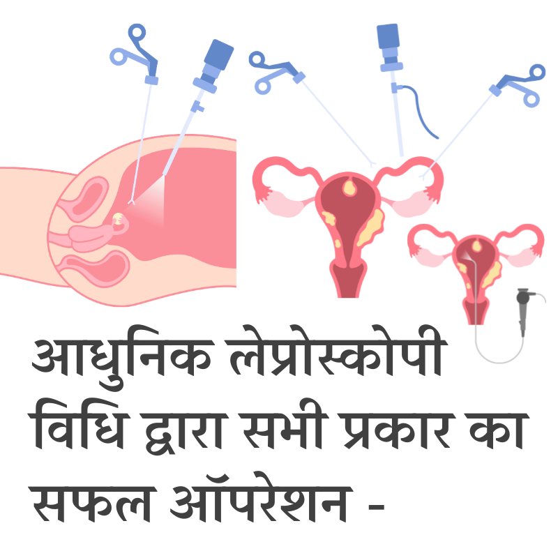 आधुनिक लेप्रोस्कोपी द्वारा ऑपरेशन