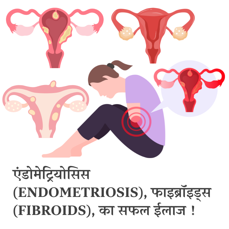 एंडोमेट्रियोसिस और फाइब्रॉयड का इलाज